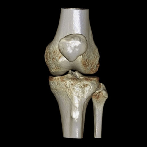 3D---CT-Bone