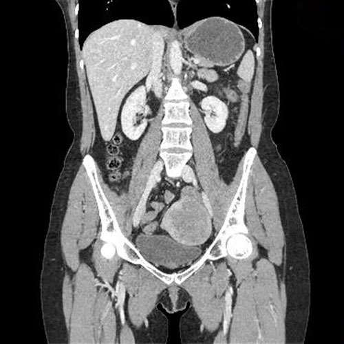 CT-Abdomen