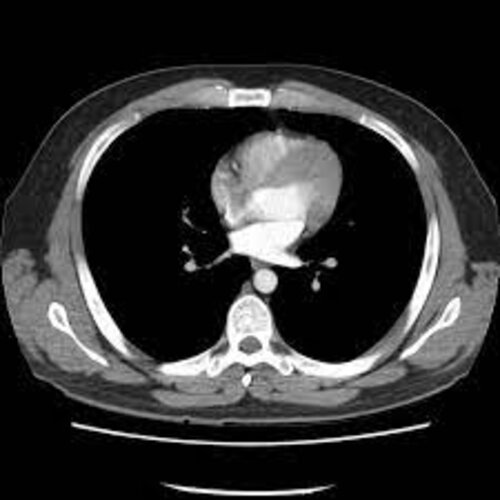 CT Thorax