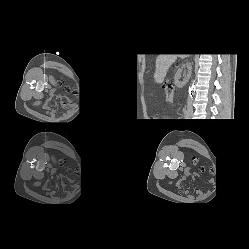 CT-guided-interventions3