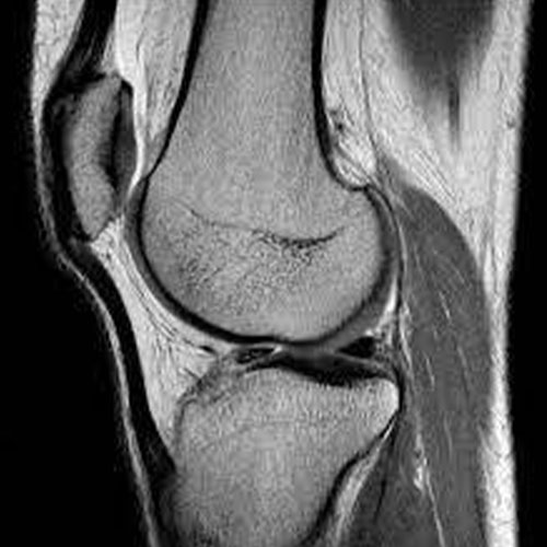 MRI-Knee