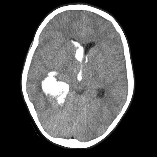 CT Scan brain