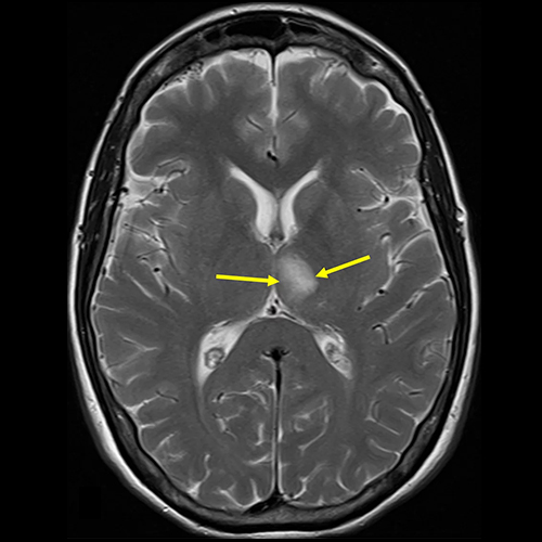 mri_brain (1)